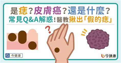 生黑痣|是痣or皮膚癌？醫「1張圖秒對照」 長這2部位最危險